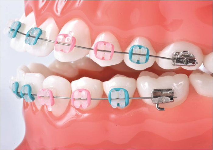 Ceramic Braces - Billericay Orthodontics