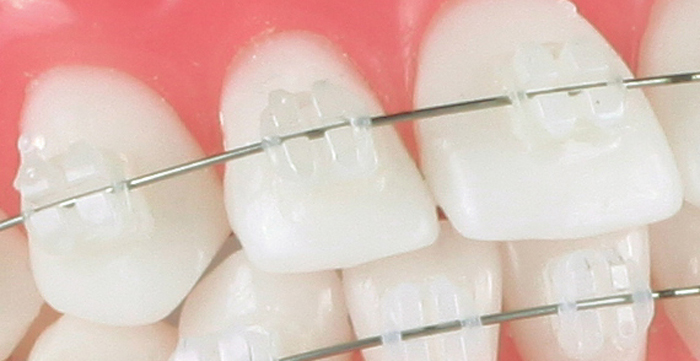 Ceramic Braces - Billericay Orthodontics