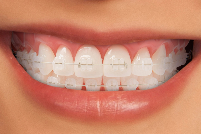 Ceramic Braces