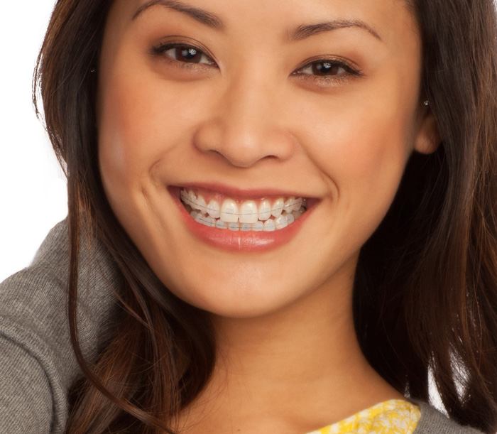 Ceramic Braces - Billericay Orthodontics