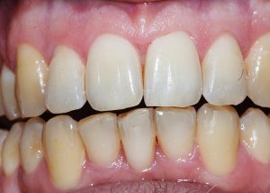 Adult Male Treatment for Crooked Teeth