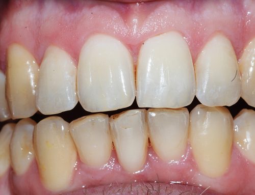 Adult Male Treatment for Crooked Teeth