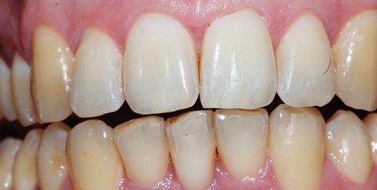 Adult Male Treatment for Crooked Teeth