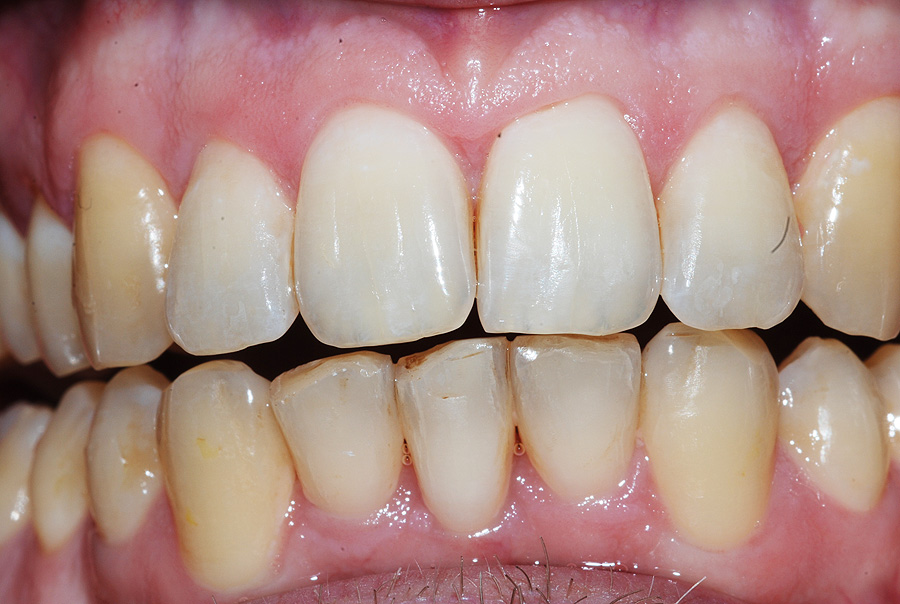 Adult Male Treatment for Crooked Teeth